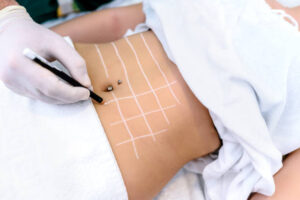 What are the risks associated with liposuction?