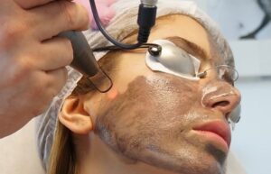 Discover the Magic of Spectra Laser Carbon Peel